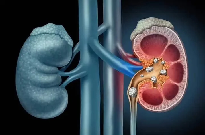 kidney stone diagram