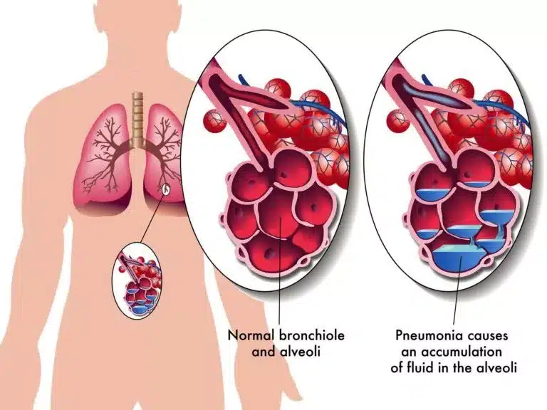 pneumonia disease picture