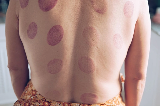 Cupping therapy marks