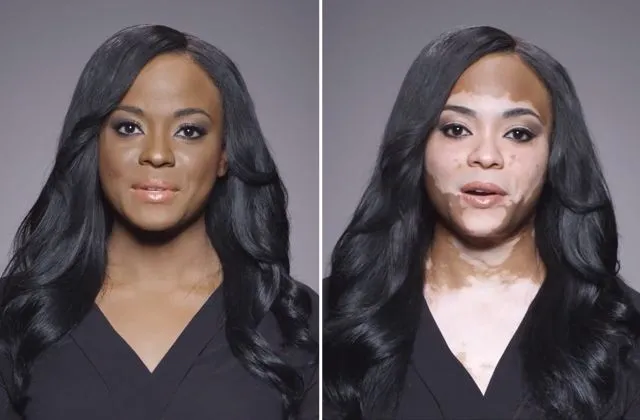 change in vitiligo before and after picture