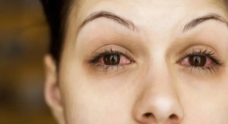 pink eye causes symptoms and treatment