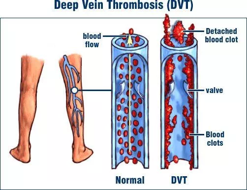 Deep venous thrombosis digram
