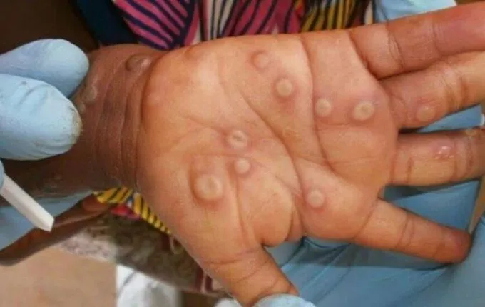 monkeypox virus on palm