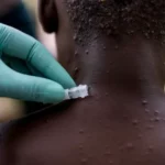 monkeypox virus on back