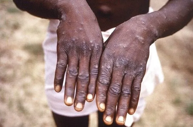 monkeypox virus on both hands