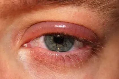 eye inflammation