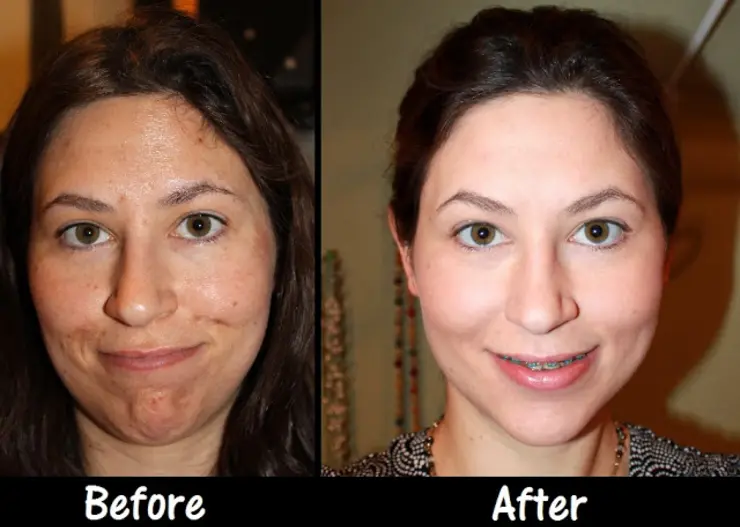 Chemical peel difference in a women face before and after
