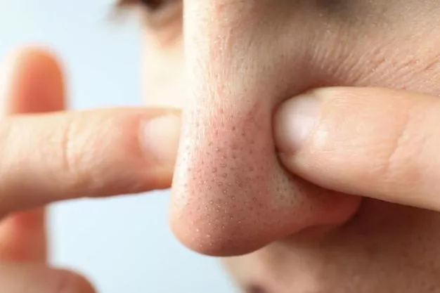 blackheads on nose picture